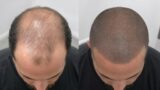 hair transplant vs smp