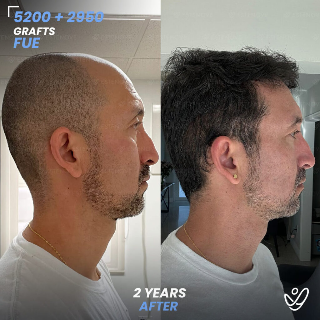 Second Hair Transplant Before After - FUE 5200 + 2950 Grafts - Wilmer Sanchez