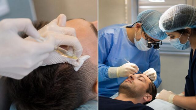 stem cell vs standard hair transplant