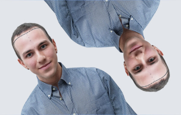 Hair transplant patient