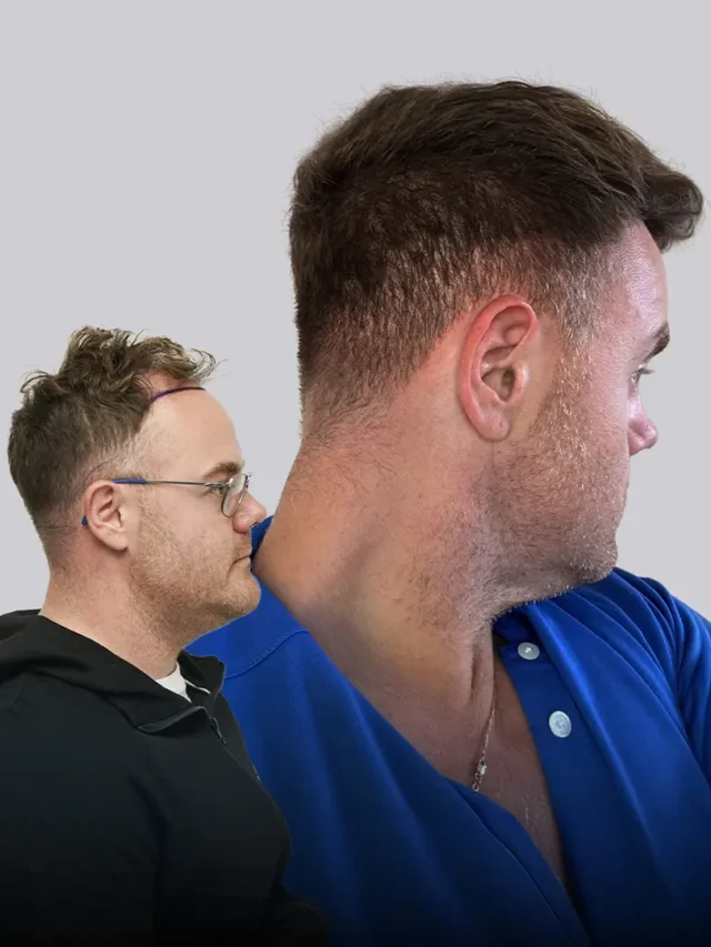 Michael Champoux transformation - 2