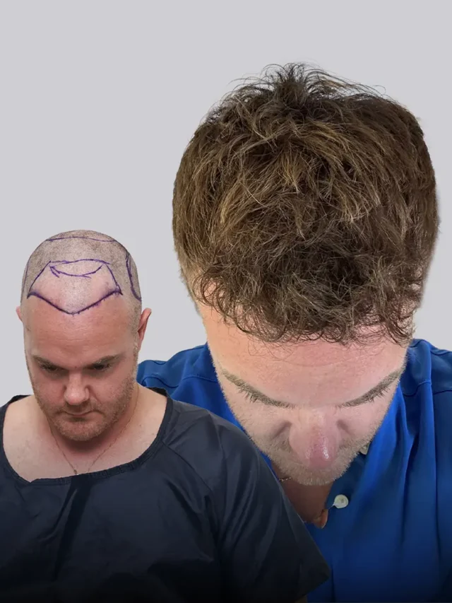 Michael Champoux transformation - 3