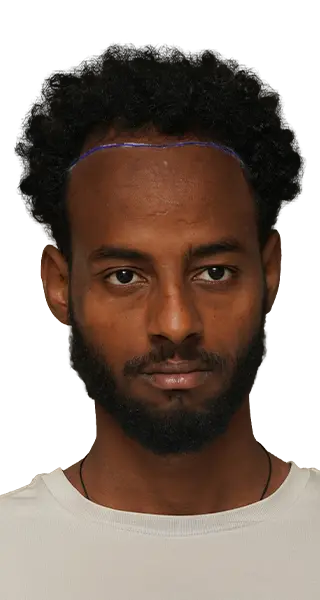 Teame Tadese Gebrezganiher - BEFORE