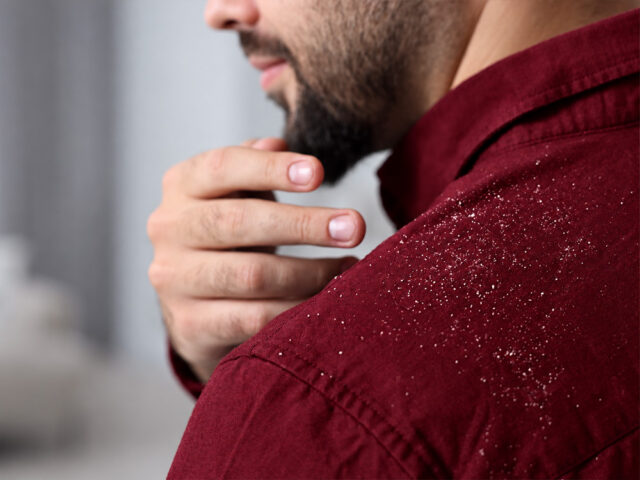 does dandruff cause hair loss