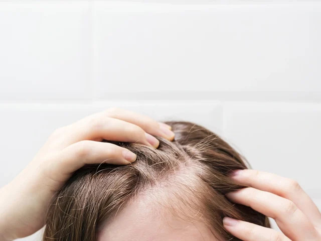 scalp folliculitis treatment and causes