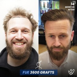 Male FUE 3600 grafts 14 Months Before&After Male FUE 3600 grafts 14 Months Before&After