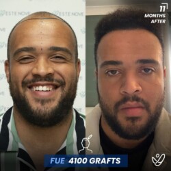 Male FUE 4100 grafts 11 Months Before&After Male FUE 4100 grafts 11 Months Before&After