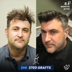 DHI 3700 Grafts Male DHI 3700 grafts 8.5 Months Before&After