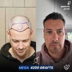 Mega 4200 Grafts Male Mega 4200 grafts 6 Months Before&After