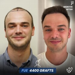 FUE 4400 Grafts Male FUE 4400 grafts 7 Months Before&After