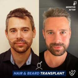 Beard Transplant 8 Months Before&After Beard Transplant 8 Months Before&After