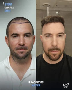 3100 graft before & 9 months after hair transplant, DHI 3100 graft before & 9 months after hair transplant, DHI