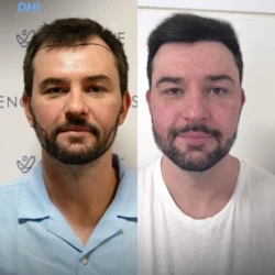 3800 graft before & 6 months after hair transplant, DHI 3800 graft before & 6 months after hair transplant, DHI