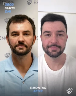3800 graft before & 6 months after hair transplant, DHI 3800 graft before & 6 months after hair transplant, DHI