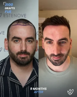 3100 graft before & 9 months after hair transplant, FUE 3100 graft before & 9 months after hair transplant, FUE