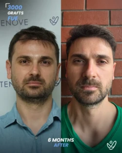 3000 graft before & 6 months after hair transplant, FUE 3000 graft before & 6 months after hair transplant, FUE