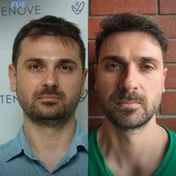 3000 graft before & 6 months after hair transplant, FUE 3000 graft before & 6 months after hair transplant, FUE