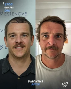 3700 graft DHI 6 months before & after hair transplant 3700 graft DHI 6 months before & after hair transplant