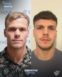 3800 graft DHI 9 months before & after hair transplant 3800 graft DHI 9 months before & after hair transplant