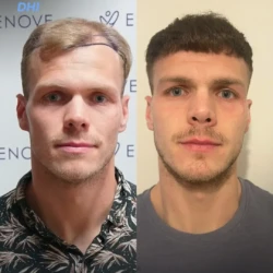 3800 graft DHI 9 months before & after hair transplant 3800 graft DHI 9 months before & after hair transplant