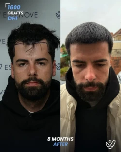 1600 graft DHI 8 months before & after hair transplant 1600 graft DHI 8 months before & after hair transplant
