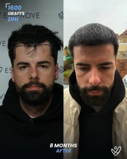 1600 graft DHI 8 months before & after hair transplant 1600 graft DHI 8 months before & after hair transplant