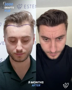 3000 graft FUE 9 months before & after hair transplant 3000 graft FUE 9 months before & after hair transplant
