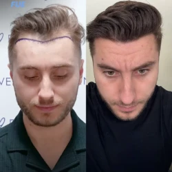 3000 graft FUE 9 months before & after hair transplant 3000 graft FUE 9 months before & after hair transplant
