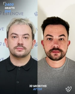 2400 graft DHI 10 months before & after hair transplant 2400 graft DHI 10 months before & after hair transplant