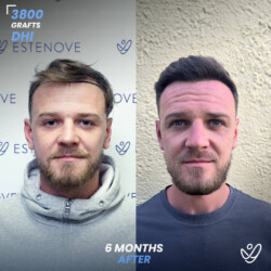 Male DHI 3800 Grafts 6 Months Before&After Male DHI 3800 Grafts 6 Months Before&After
