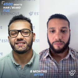 Male FUE 4500 Grafts 6 Months Before&After Male FUE 4500 Grafts 6 Months Before&After