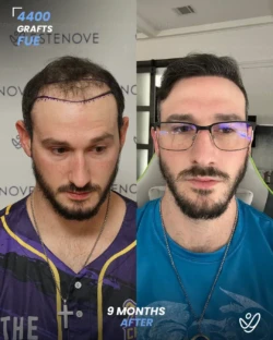 4400 graft Before & 9 months After Hair transplant 4400 graft Before & 9 months After Hair transplant FUE