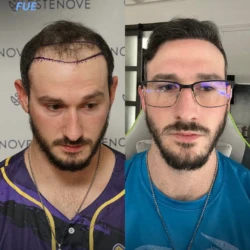 4400 graft Before & 9 months After Hair transplant 4400 graft Before & 9 months After Hair transplant FUE