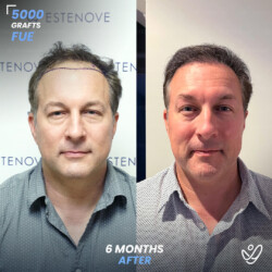 Male FUE 5000 Grafts 6 Months Before&After Male FUE 5000 Grafts 6 Months Before&After