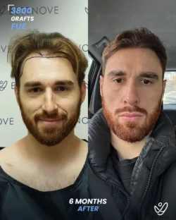 3800 graft Before & 6 months After Hair transplant 3800 graft Before & 6 months After Hair transplant FUE