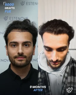 5000 grafts Before & 9 months After Hair transplant, FUE 5000 grafts Before & 9 months After Hair transplant, FUE