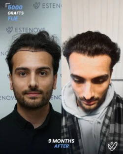 5000 grafts Before & 9 months After Hair transplant, FUE 5000 grafts Before & 9 months After Hair transplant, FUE