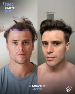 3000 graft Before & 9 months After Hair transplant, DHI 3000 graft 9 motnhs Before & After Hair transplant DHI