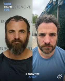 5100 graft before & 9 months after hair transplant, FUE 5100 graft before & 9 months after hair transplant, FUE