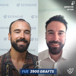 Male FUE 3900 Grafts 6 Months Before&After Male FUE 3900 Grafts 6 Months Before&After