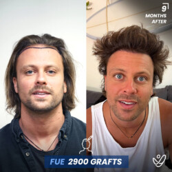 Male FUE 2900 Grafts 9 Months Before&After Male FUE 2900 Grafts 9 Months Before&After