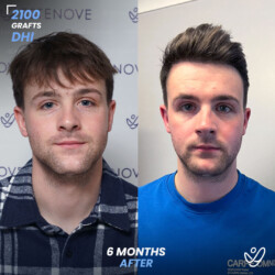 Male DHI 2100 Grafts 6 Months Before&After Male DHI 2100 Grafts 6 Months Before&After