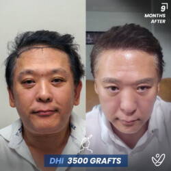 Male DHI 3500 Grafts 9 Months Before&After Male DHI 3500 Grafts 9 Months Before&After