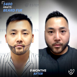 Male FUE 3400 Grafts 9 Months Before&After Male FUE 3400 Grafts 9 Months Before&After