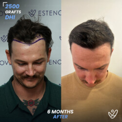 DHI 2500 Grafts 6 Months Before&After DHI 2500 Grafts 6 Months Before&After