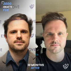 Male DHI 3600 Grafts 10 Months Before&After Male DHI 3600 Grafts 10 Months Before&After