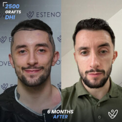 Male DHI 2500 Grafts 6 Months Before&After Male DHI 2500 Grafts 6 Months Before&After