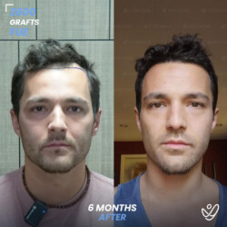 DHI 2600 Grafts 6 Months Before&After Male DHI 2600 Grafts 6 Months Before&After