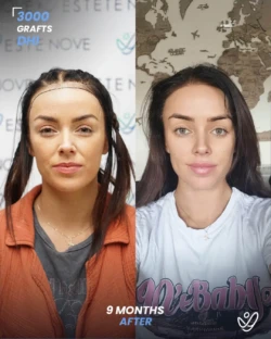 Female Hair Transplant in Turkey | Rachel's New Hair | Before and After Female Hair Transplant in Turkey | Rachel's New Hair | Before and After