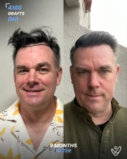 Male FUE 4700 grafts 6 Months Before&After Male FUE 4700 grafts 6 Months Before&After